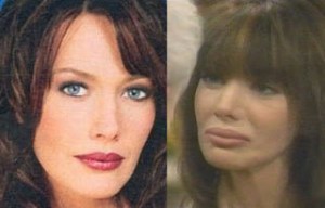 HUNTER TYLO, PLASTIC SURGERY, PLASTISCHE CHIRURGIE,